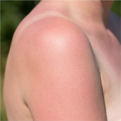 Skin that reddens and burns quickly - light, usually cool coloring