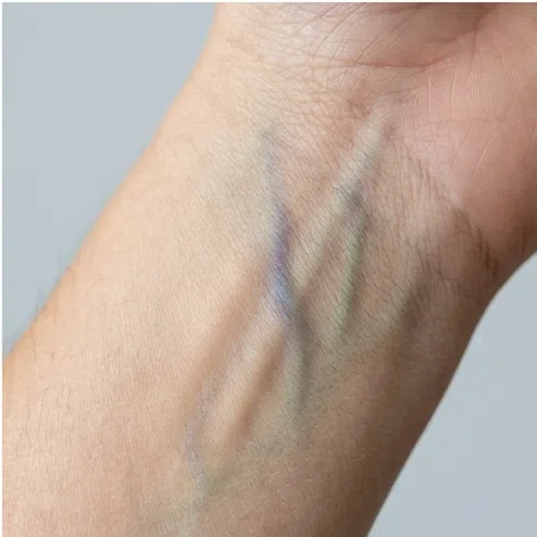 Mixed blue and green veins - a neutral skin undertone